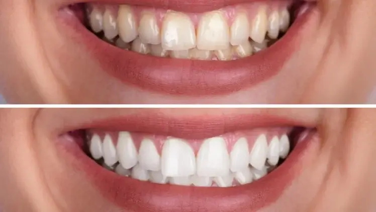 Résultat esthétique après traitement en clinique dentaire haut de gamme